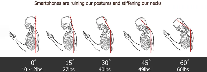 Tech Neck: Phone Posture Is Wrecking Necks
